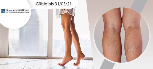 Besenreiserbehandlung mit Injektion