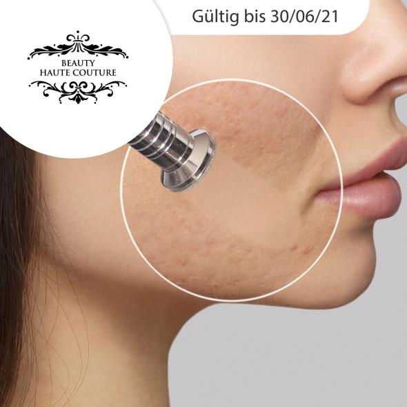 Microdermabrasion