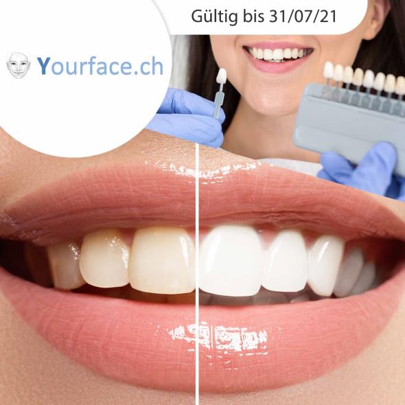 Powerbleaching