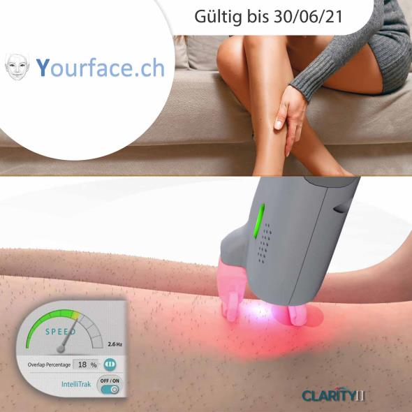 Haarentfernung per Alexandrit-Laser