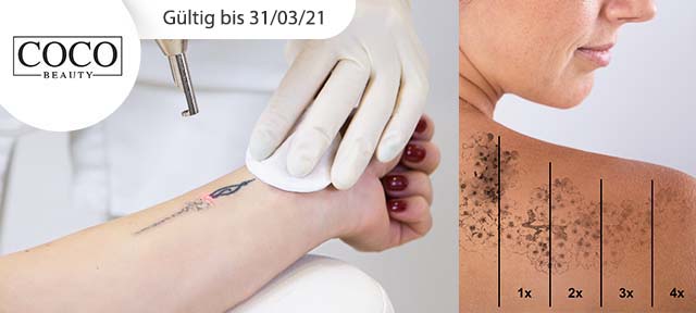 Tattooentfernung
