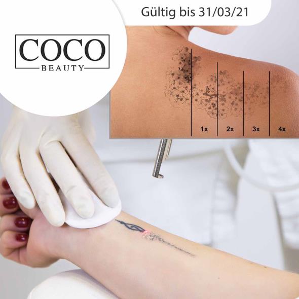Tattooentfernung