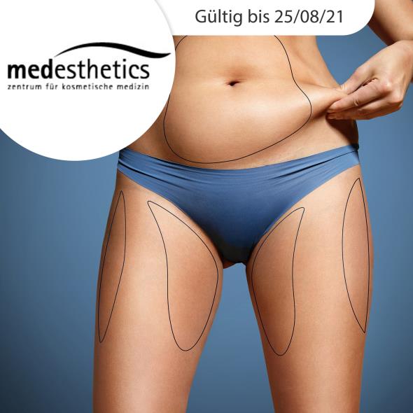 Liposuktion