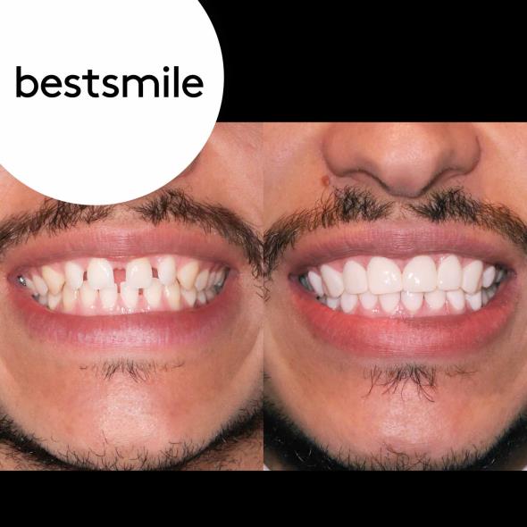 Hollywood-Smile mit Veneers